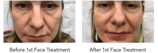 HydraFacial Perk for Full Face