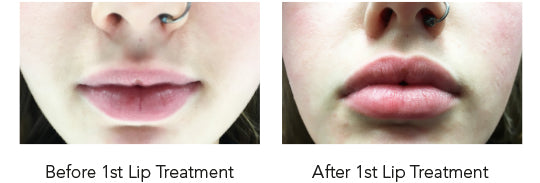 HydraFacial Perk Express Treatment for Lips 3+1 FREE (save €50)