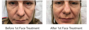 HydraFacial Perk for Full Face