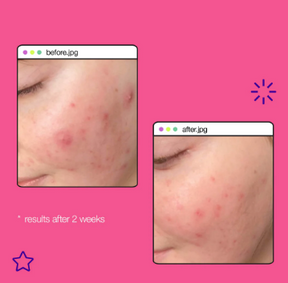 Dermalogica Breakout Clearing Liquid Peel