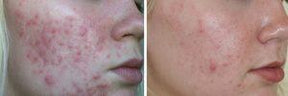 Advanced Nutrition Programme Skin Accumax (180 Capsules)