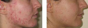 Advanced Nutrition Programme Skin Accumax (180 Capsules)